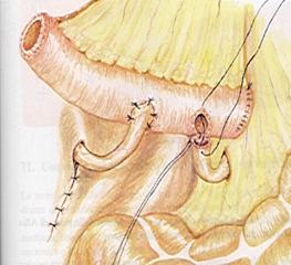 Terapia del tumore della vescica — figura 23