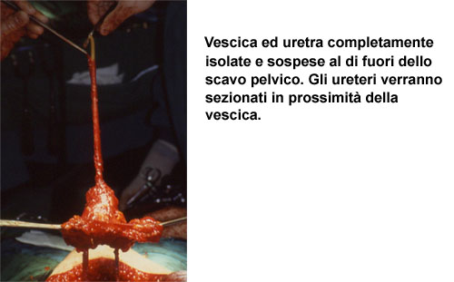 Terapia del tumore della vescica — figura 31