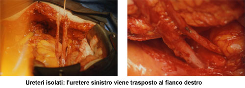 Terapia del tumore della vescica — figura 32
