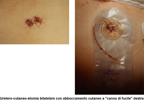 Terapia del tumore della vescica — figura 33