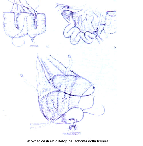 Sono stati descritti diversi tipi di neovescica ileale ortotopica continente — Terapia del tumore della vescica