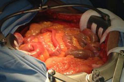 Terapia del tumore del testicolo — figura 4