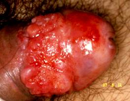 Terapia del tumore del pene — figura 22