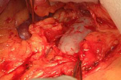Terapia del tumore del testicolo — figura 5