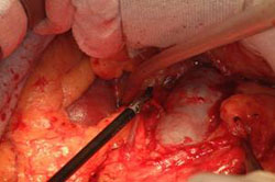 Terapia del tumore del testicolo — figura 6