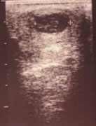 Terapia del tumore del pene — figura 24