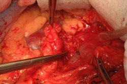 Terapia del tumore del testicolo — figura 7