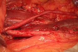 Terapia del tumore del testicolo — figura 16
