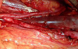 TERAPIA: Tumori a cellule germinali localizzati al testicolo ( Stadio clinico I) — Terapia del tumore del testicolo