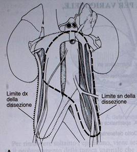 TERAPIA: Tumori a cellule germinali localizzati al testicolo ( Stadio clinico I) — Terapia del tumore del testicolo