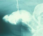 "GLANDULECTOMIA NERVE SPARING"(Austoni1994) — Terapia del tumore del pene
