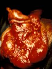 "GLANDULECTOMIA NERVE SPARING"(Austoni1994) — Terapia del tumore del pene