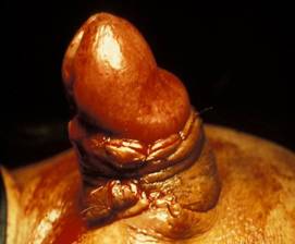 "GLANDULECTOMIA NERVE SPARING"(Austoni1994) — Terapia del tumore del pene
