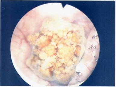 Calcolo vescicale — Ipertrofia Prostatica Benigna