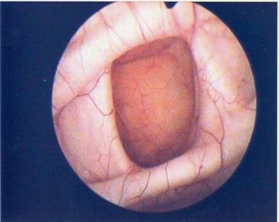 Diverticolo vescicale — Ipertrofia Prostatica Benigna