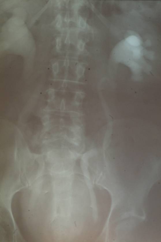 Uroteroidronefrosi bilaterale da ostruzione cervico-uretrale prostatica — Ipertrofia Prostatica Benigna