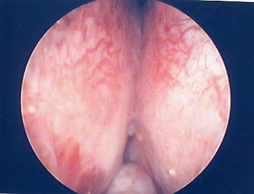Immagine endoscopica di ghiandola prostatica occludente il lume uretrale — Ipertrofia Prostatica Benigna