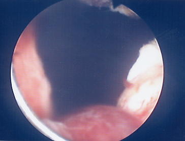 Immagine endoscopica di loggia prostatica dopo resezione prostatica disostruttiva — Ipertrofia Prostatica Benigna