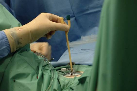 Sostituzione del trokar con catetere tipo Foley epicistostomico — Ipertrofia Prostatica Benigna