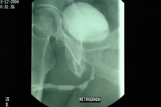 Uretrocistografia retrograda: plurime stenosi uretrali — Ipertrofia Prostatica Benigna