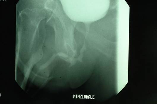 Uretrocistografia minzionale: plurime stenosi uretrali — Ipertrofia Prostatica Benigna