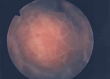Neoplasia vescicale — Ipertrofia Prostatica Benigna