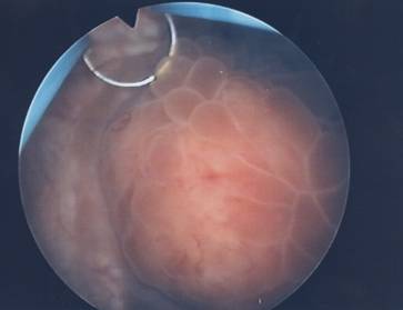 Inizio della resezione endoscopica della neoplasia — Ipertrofia Prostatica Benigna