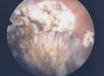 Risultato finale della resezione endoscopica della neoplasia — Ipertrofia Prostatica Benigna
