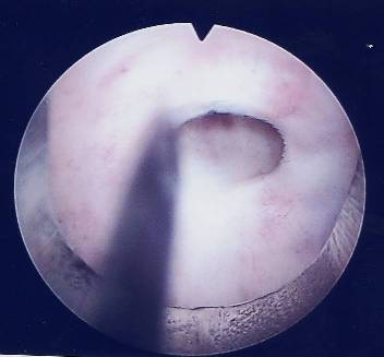 Stenosi uretrale — Ipertrofia Prostatica Benigna