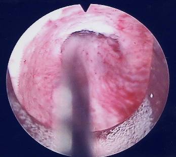 Canale uretrale — Ipertrofia Prostatica Benigna