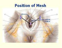Sling tension free — Urodinamica