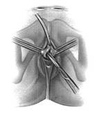 Sling tension free — Urodinamica