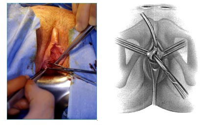 Sling tension free — Urodinamica