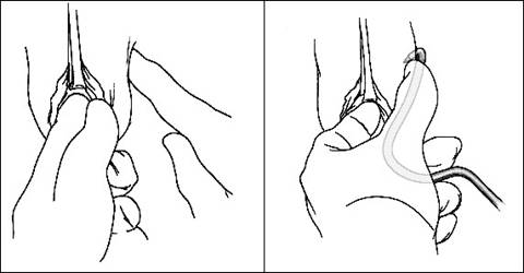 Sling tension free — Urodinamica