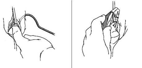 Sling tension free — Urodinamica