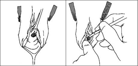 Sling tension free — Urodinamica