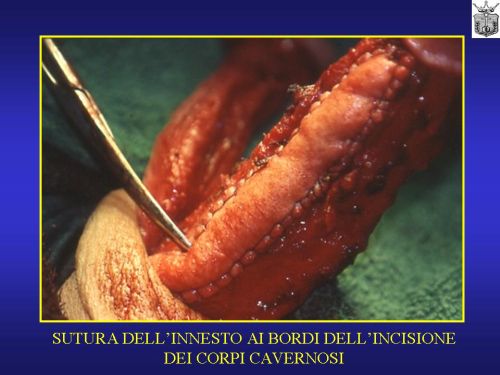 Micropene — Malformazioni congenite
