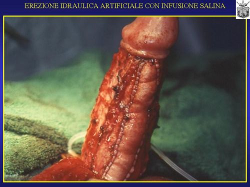 Micropene — Malformazioni congenite