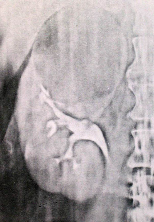 Anomalie di struttura — Malformazioni renali