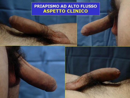 Priapismo — figura 13