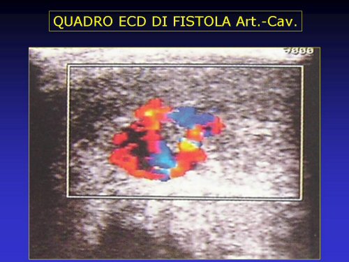 Priapismo — figura 14