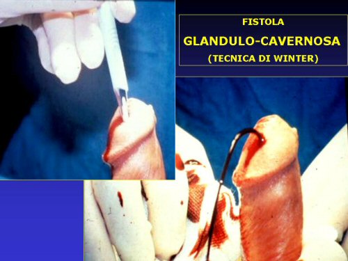 - cavrnosolusi trans-glandulare (Austoni 1984) — Priapismo