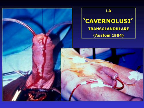 - shunt spongio-cavernoso a livello dell'uretra bulbare (Sacher 1972) — Priapismo