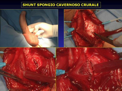 - shunt spongio-cavernoso a livello dell'uretra bulbare (Sacher 1972) — Priapismo