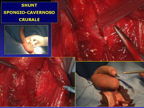 - shunt spongio-cavernoso a livello dell'uretra bulbare (Sacher 1972) — Priapismo