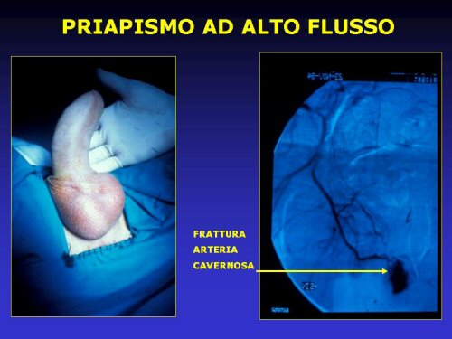- embolizzazione selettiva (o superselettiva) del ramo arterioso prossimale alla fistola — Priapismo