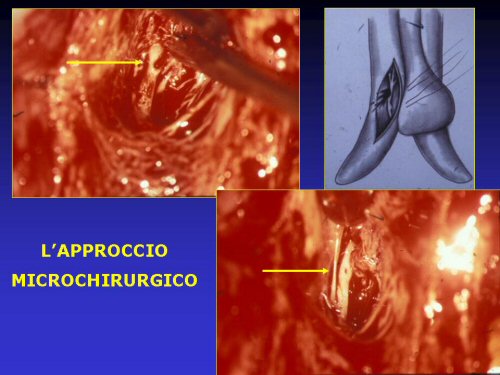 - embolizzazione selettiva (o superselettiva) del ramo arterioso prossimale alla fistola — Priapismo