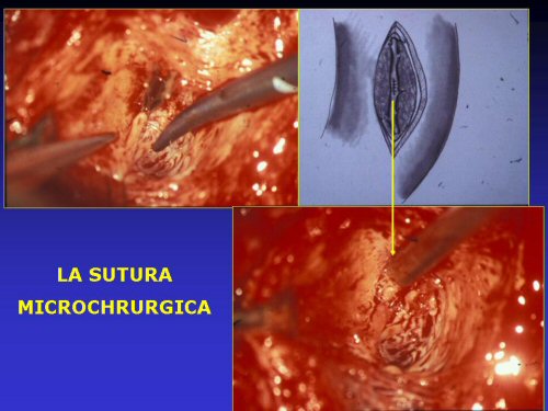 - embolizzazione selettiva (o superselettiva) del ramo arterioso prossimale alla fistola — Priapismo