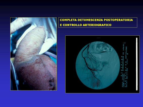 - embolizzazione selettiva (o superselettiva) del ramo arterioso prossimale alla fistola — Priapismo