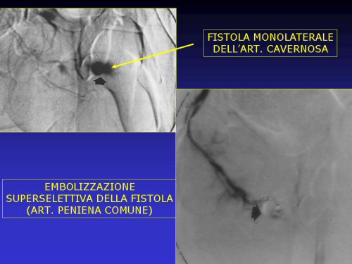 - embolizzazione selettiva (o superselettiva) del ramo arterioso prossimale alla fistola — Priapismo